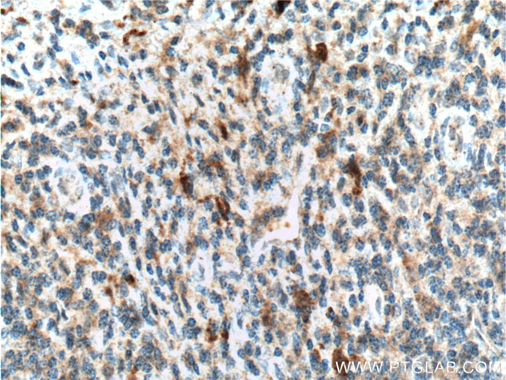 Immunohistochemistry (IHC) staining of human tonsillitis tissue using IL-1 Beta Polyclonal antibody (16806-1-AP)