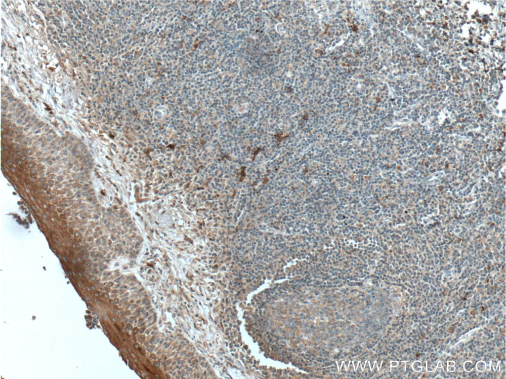 Immunohistochemistry (IHC) staining of human tonsillitis tissue using IL-1 Beta Polyclonal antibody (16806-1-AP)