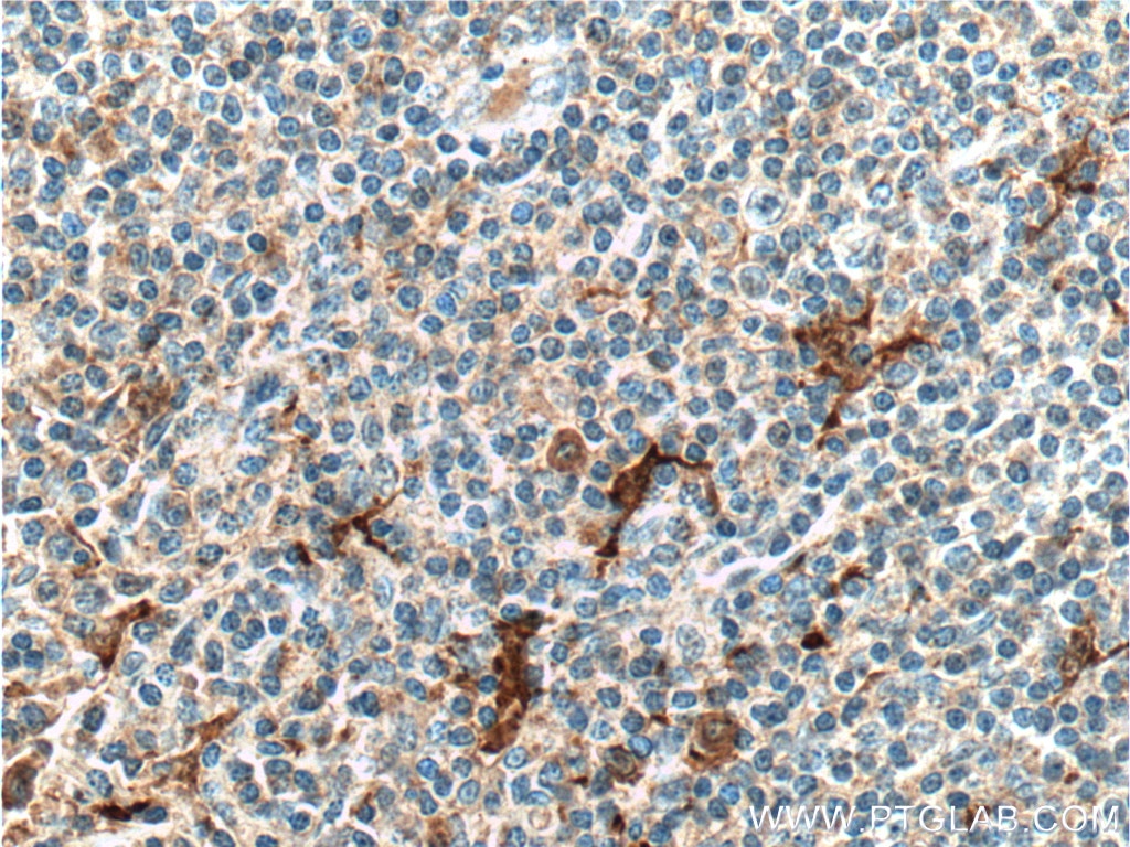 Immunohistochemistry (IHC) staining of human tonsillitis tissue using IL-1 Beta Polyclonal antibody (16806-1-AP)