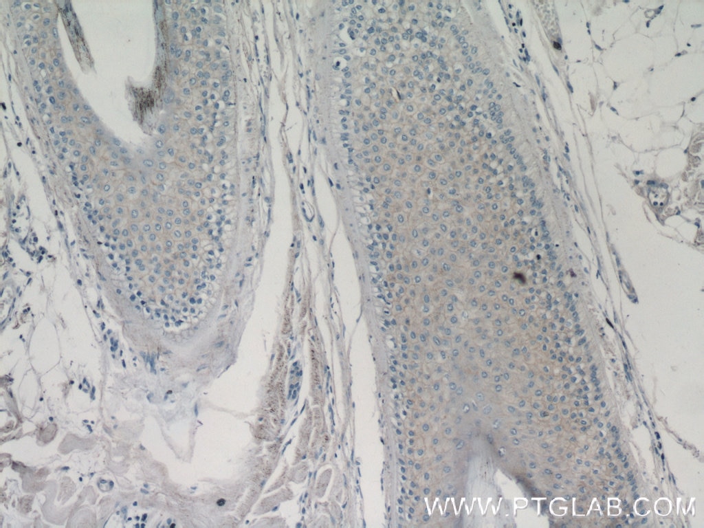 Immunohistochemistry (IHC) staining of human skin cancer tissue using IL-1 Beta Monoclonal antibody (60136-1-Ig)