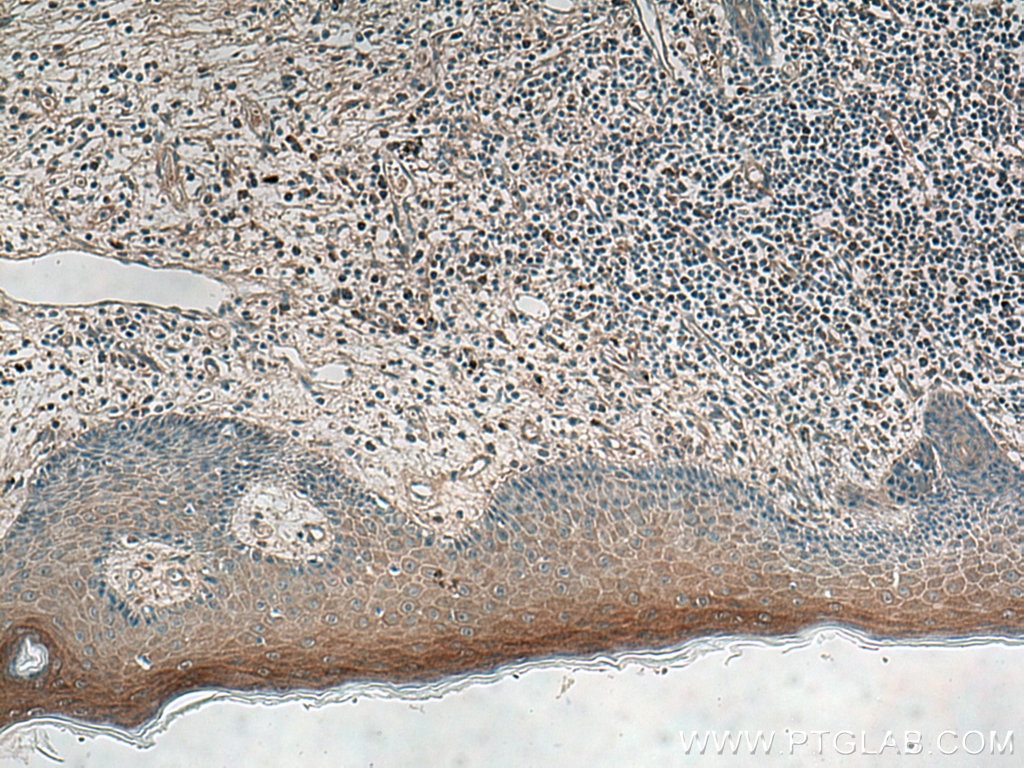 Immunohistochemistry (IHC) staining of human skin cancer tissue using IL-36RN Polyclonal antibody (13113-1-AP)