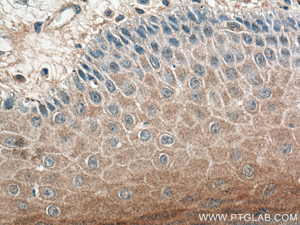 Immunohistochemistry (IHC) staining of human skin cancer tissue using IL-36RN Polyclonal antibody (13113-1-AP)