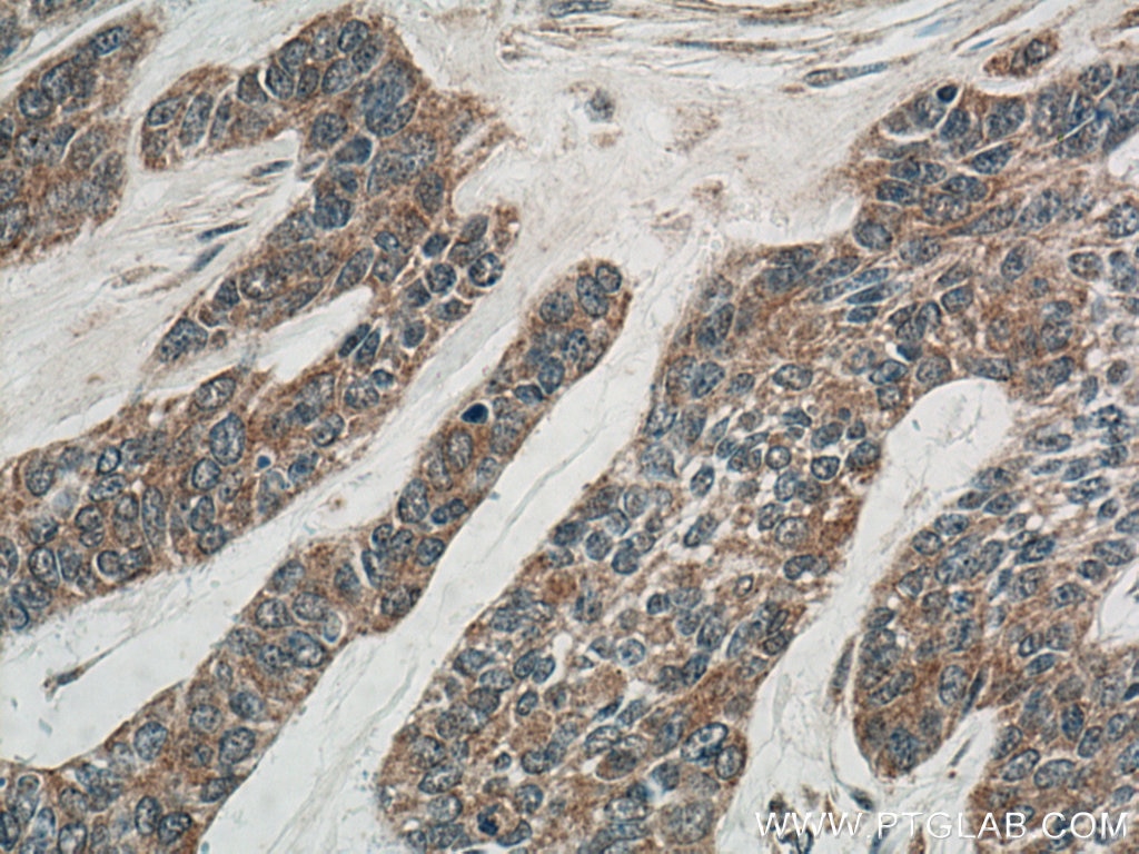 Immunohistochemistry (IHC) staining of human skin cancer tissue using IL-36RN Polyclonal antibody (13113-1-AP)