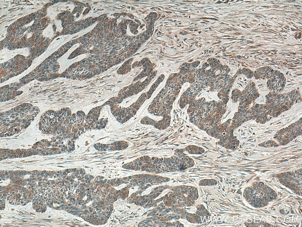 IHC staining of human skin cancer using 13113-1-AP