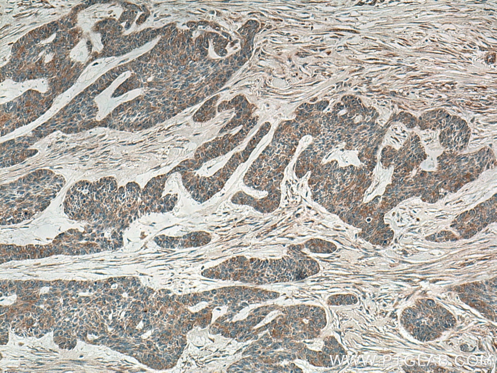 Immunohistochemistry (IHC) staining of human skin cancer tissue using IL-36RN Polyclonal antibody (13113-1-AP)