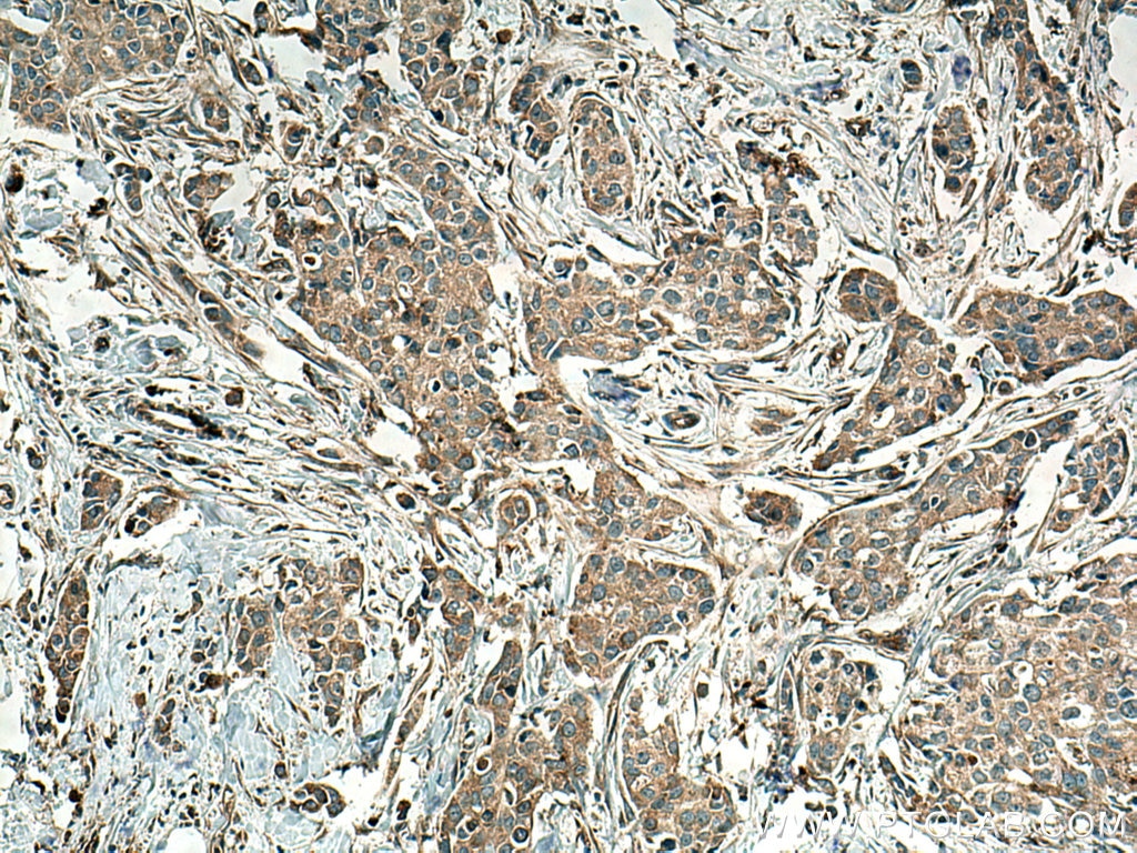 Immunohistochemistry (IHC) staining of human breast cancer tissue using IL-1F7/IL-37 Polyclonal antibody (11863-1-AP)