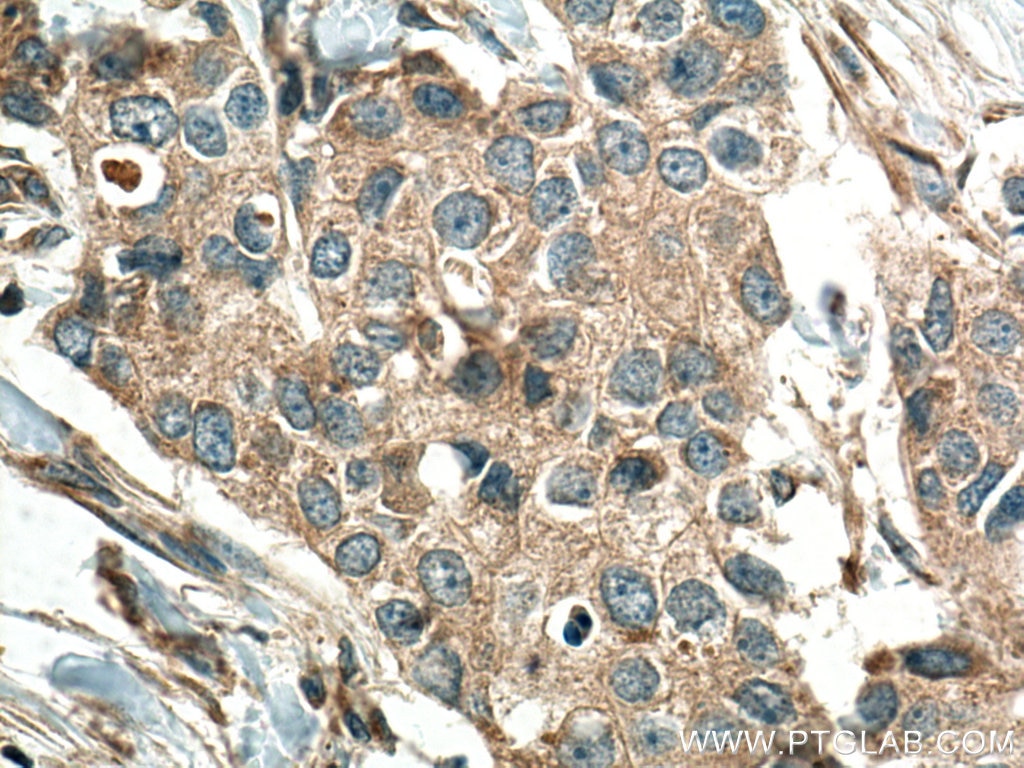 Immunohistochemistry (IHC) staining of human breast cancer tissue using IL-1F7/IL-37 Polyclonal antibody (11863-1-AP)