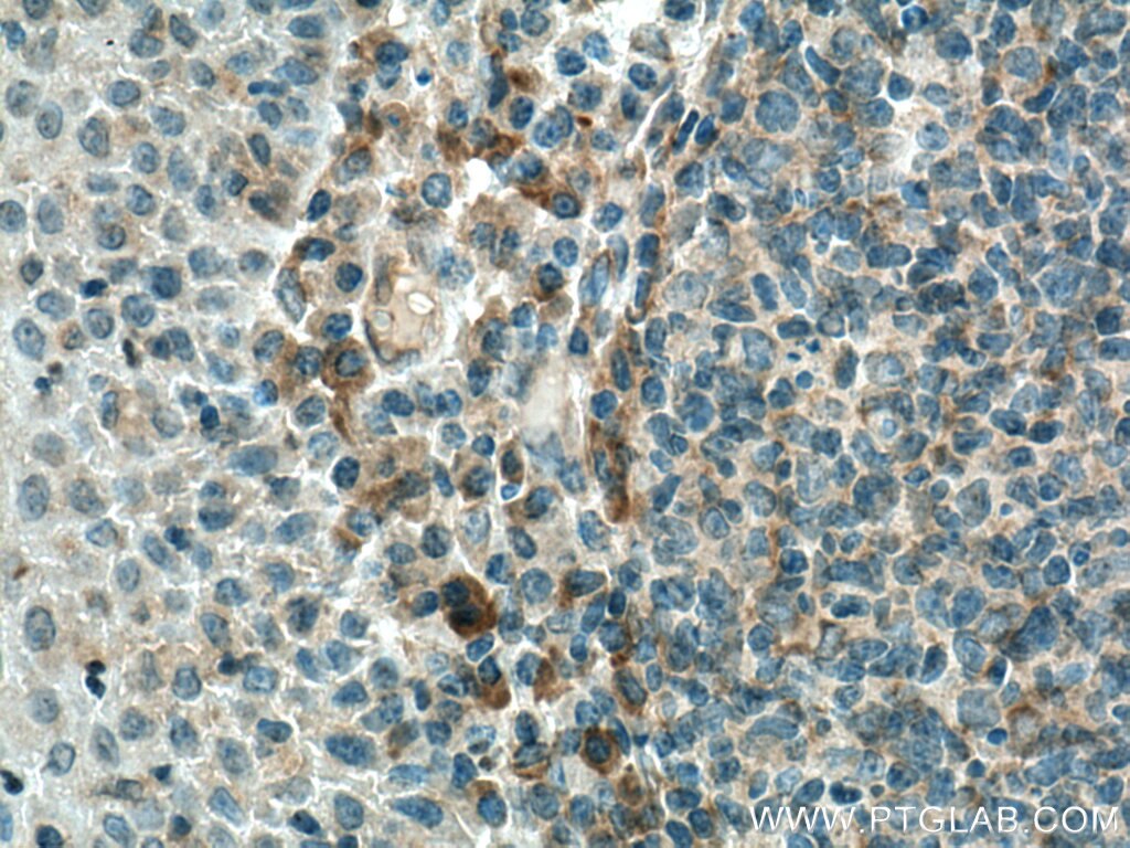 Immunohistochemistry (IHC) staining of human tonsillitis tissue using IL-1F7/IL-37 Polyclonal antibody (11863-1-AP)