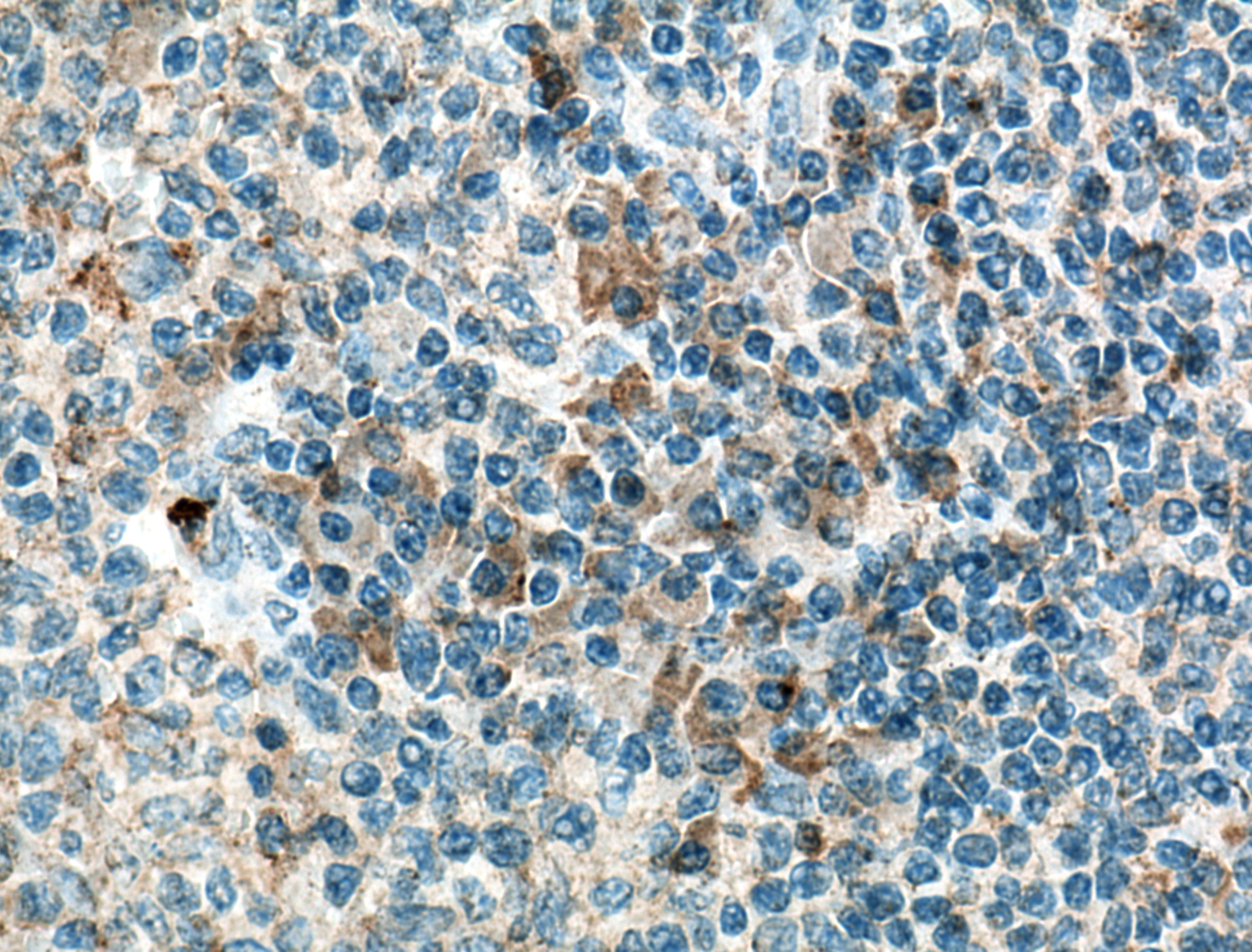 Immunohistochemistry (IHC) staining of human tonsillitis tissue using IL-36 Beta/IL-1F8 Monoclonal antibody (60290-1-Ig)