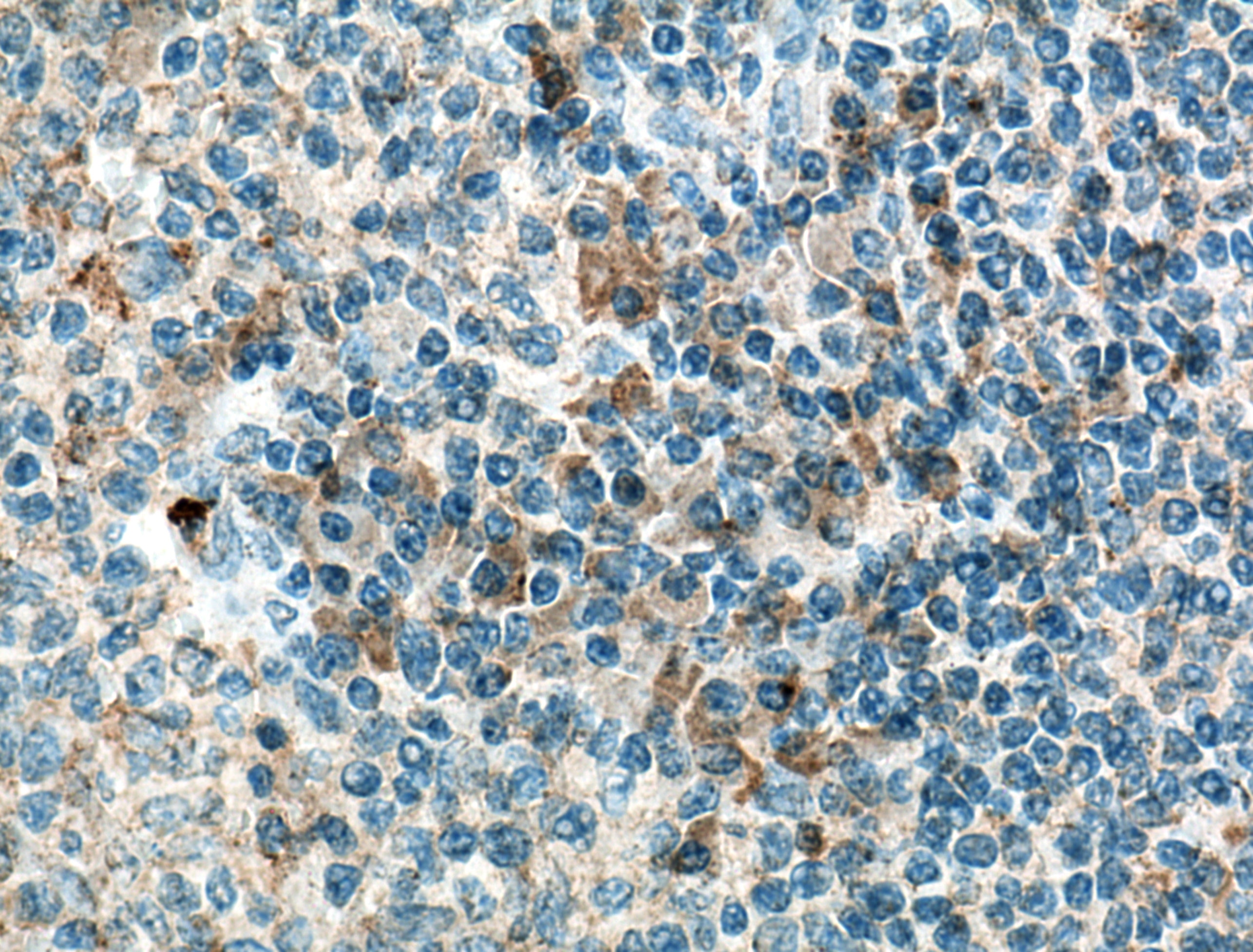 IHC staining of human tonsillitis using 60290-1-Ig