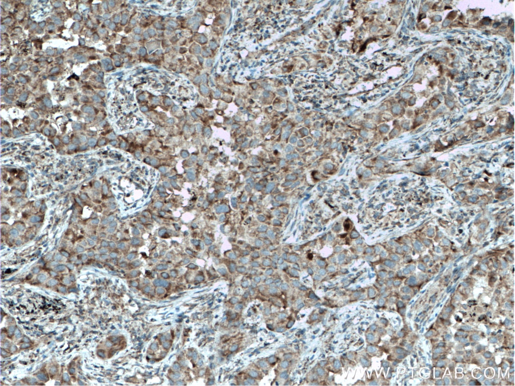 Immunohistochemistry (IHC) staining of human lung cancer tissue using ST2 Polyclonal antibody (11920-1-AP)