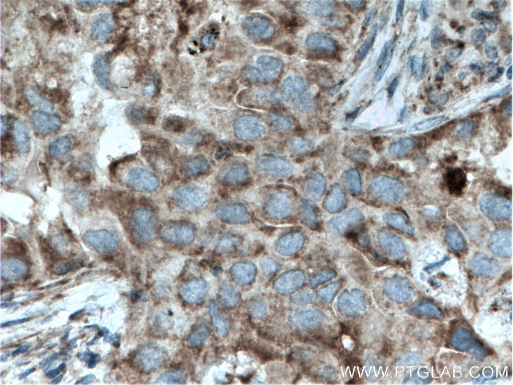Immunohistochemistry (IHC) staining of human lung cancer tissue using ST2 Polyclonal antibody (11920-1-AP)