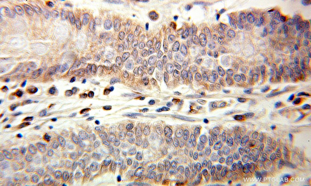 Immunohistochemistry (IHC) staining of human colon cancer tissue using IL-1RA Polyclonal antibody (10844-1-AP)