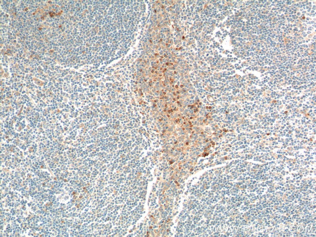 IHC staining of human tonsillitis using 60306-1-Ig