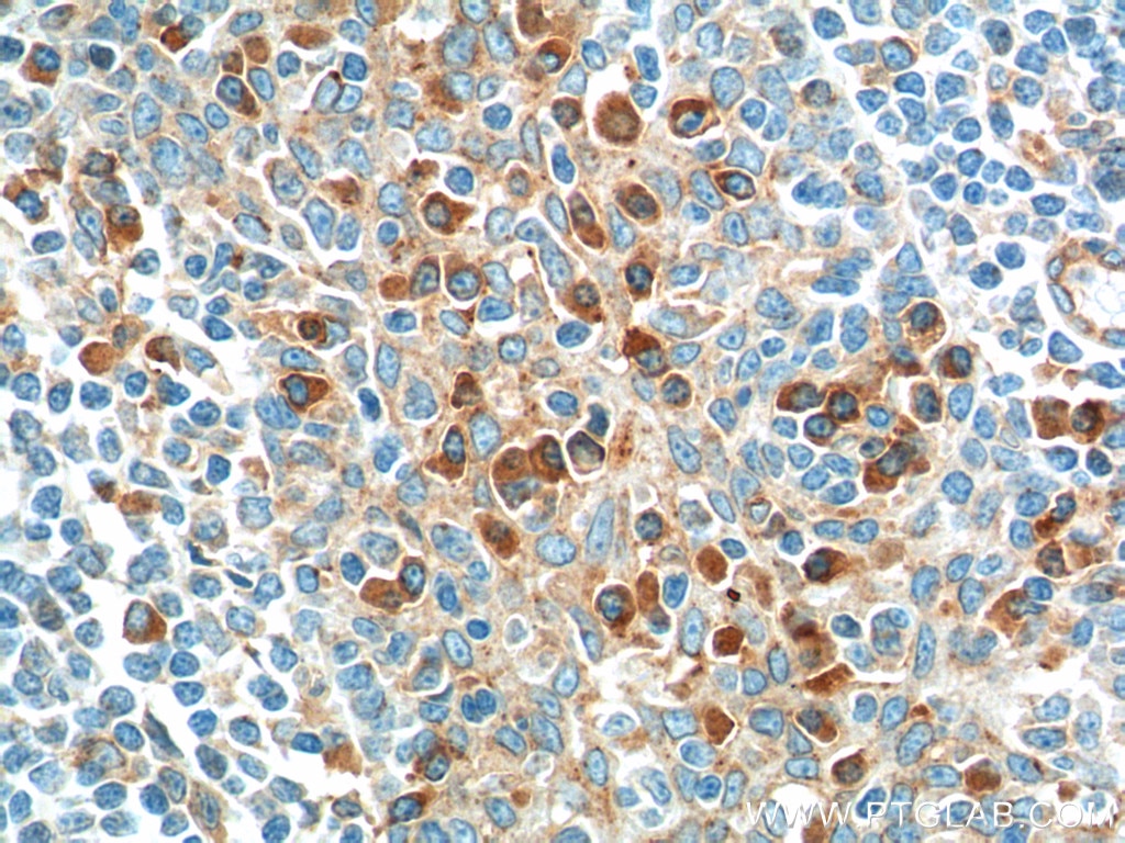 Immunohistochemistry (IHC) staining of human tonsillitis tissue using IL-2 Monoclonal antibody (60306-1-Ig)