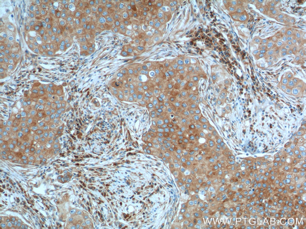 Immunohistochemistry (IHC) staining of human breast cancer tissue using IL-2 Monoclonal antibody (60306-1-Ig)