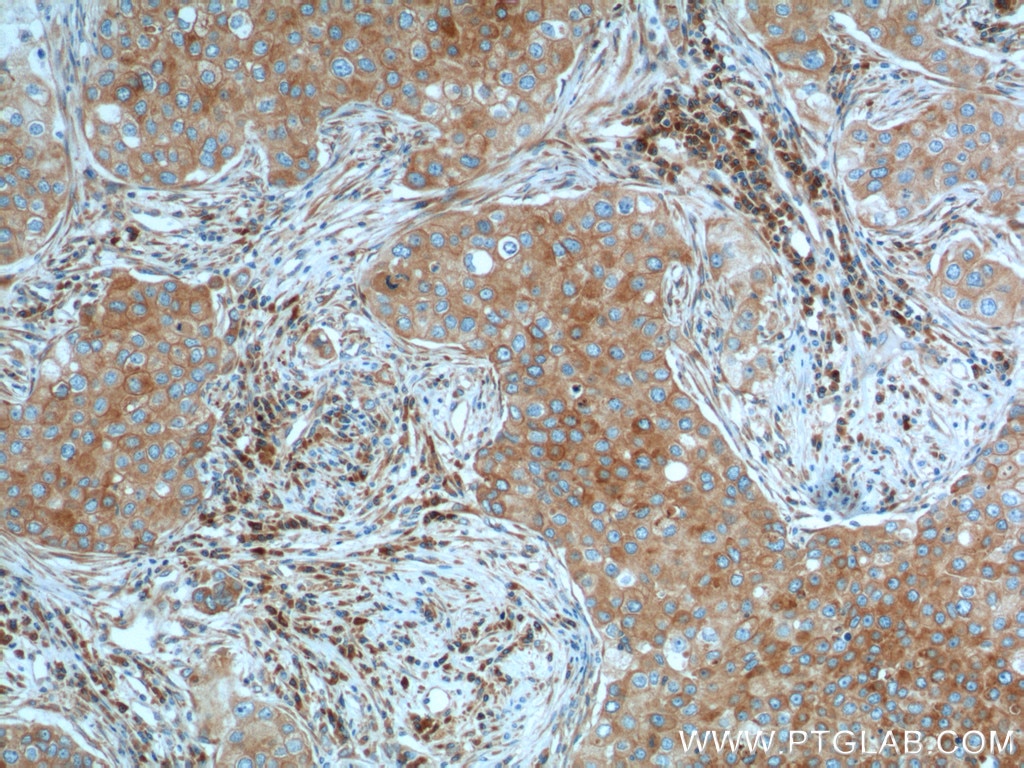 IHC staining of human breast cancer using 60306-1-Ig