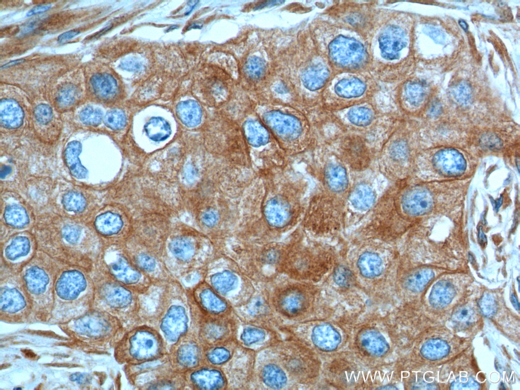 Immunohistochemistry (IHC) staining of human breast cancer tissue using IL-2 Monoclonal antibody (60306-1-Ig)