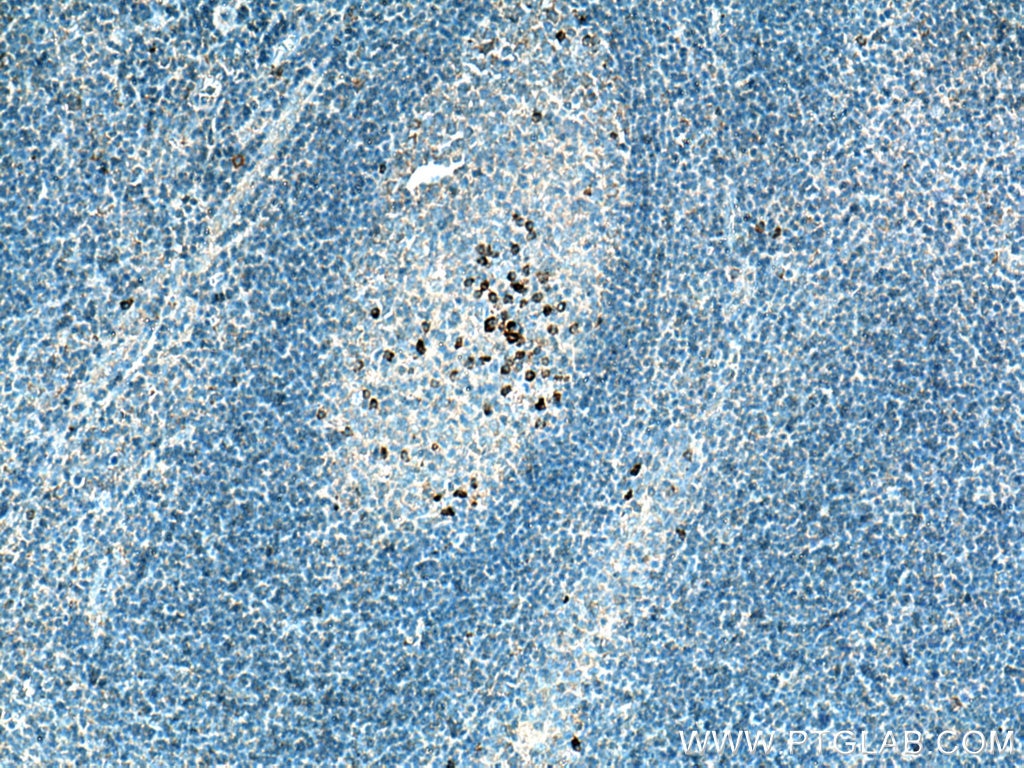 Immunohistochemistry (IHC) staining of human tonsillitis tissue using IL-20 Polyclonal antibody (18104-1-AP)