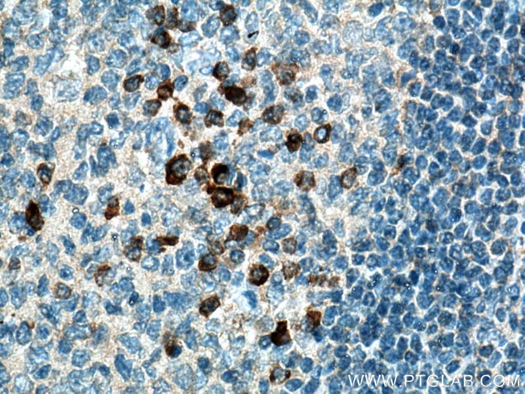 Immunohistochemistry (IHC) staining of human tonsillitis tissue using IL-20 Polyclonal antibody (18104-1-AP)