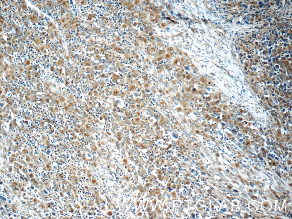 Immunohistochemistry (IHC) staining of human lymphoma tissue using IL-21R Polyclonal antibody (10533-1-AP)