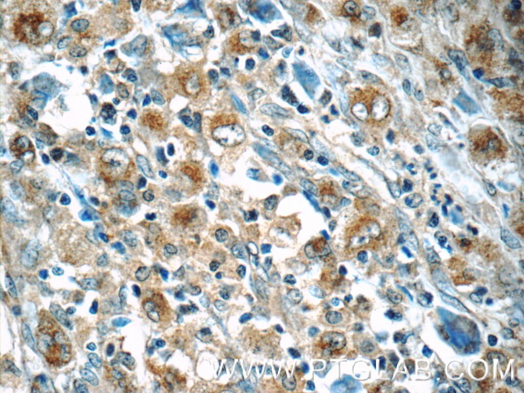 Immunohistochemistry (IHC) staining of human lymphoma tissue using IL-21R Polyclonal antibody (10533-1-AP)