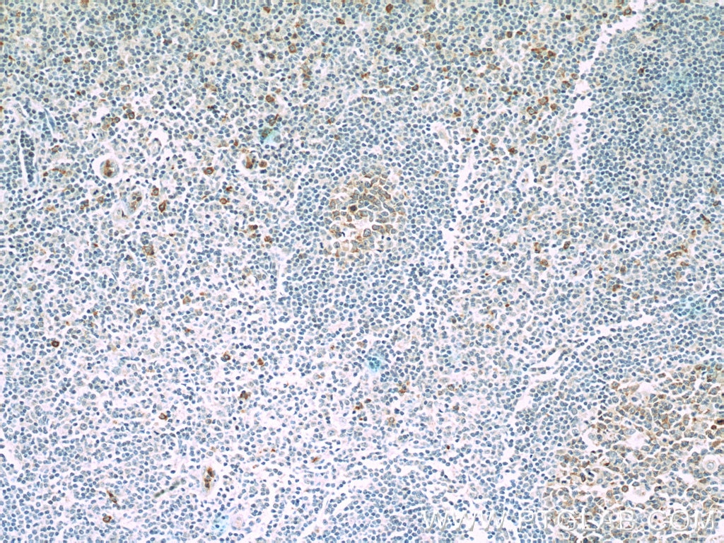 Immunohistochemistry (IHC) staining of human tonsillitis tissue using IL-21R Monoclonal antibody (66319-1-Ig)