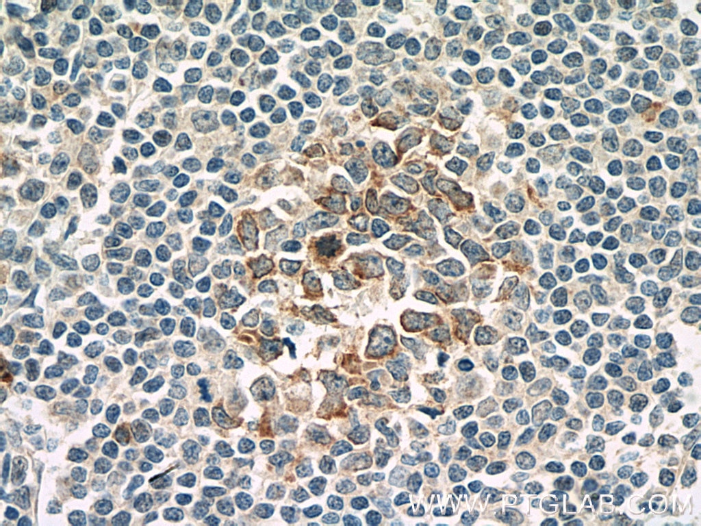 Immunohistochemistry (IHC) staining of human tonsillitis tissue using IL-21R Monoclonal antibody (66319-1-Ig)