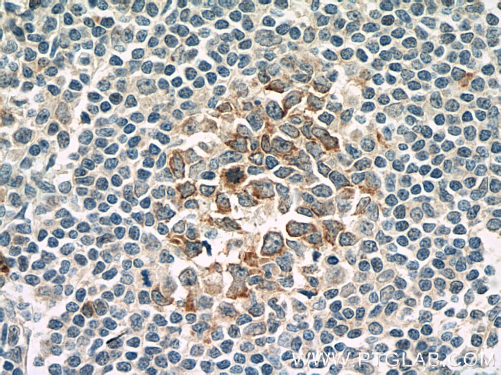 IHC staining of human tonsillitis using 66319-1-Ig