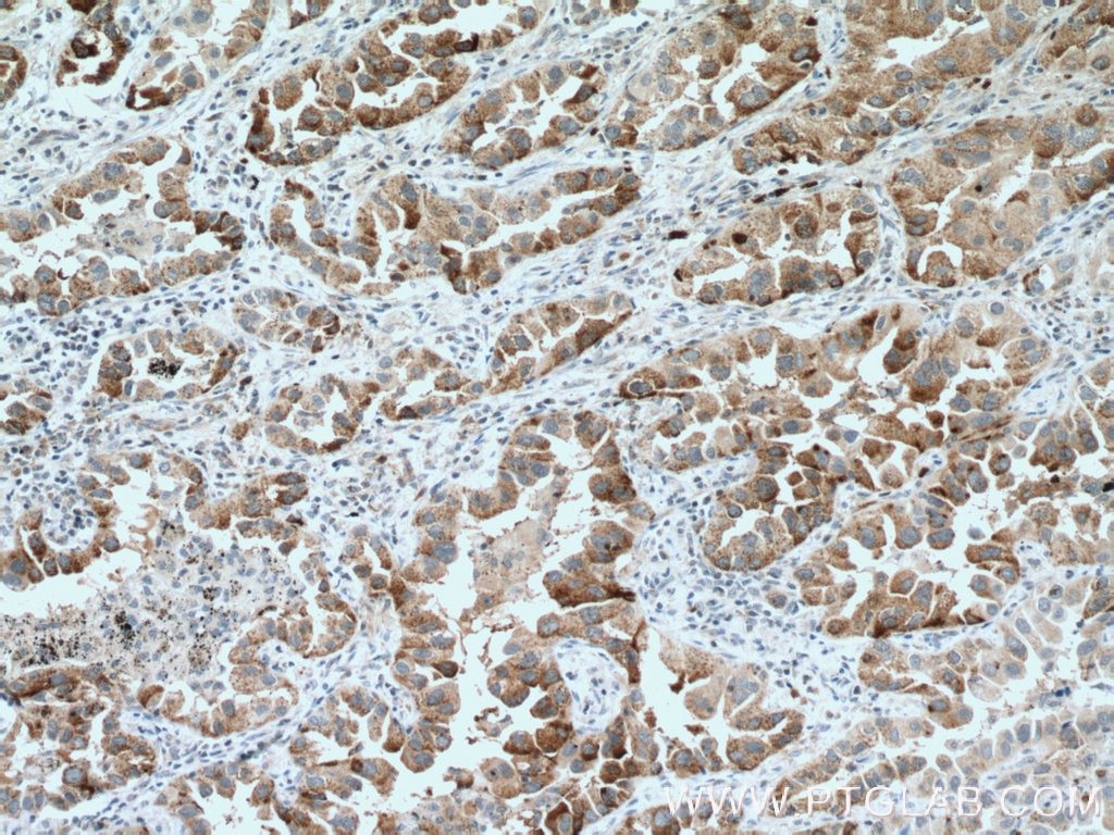 Immunohistochemistry (IHC) staining of human lung cancer tissue using IL-22RA2 Polyclonal antibody (22861-1-AP)