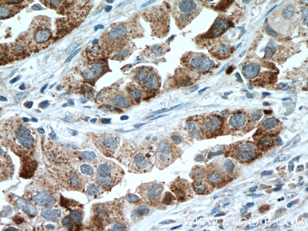 Immunohistochemistry (IHC) staining of human lung cancer tissue using IL-22RA2 Polyclonal antibody (22861-1-AP)