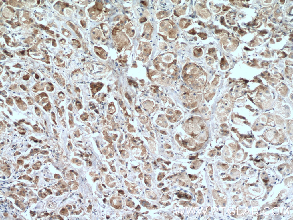 Immunohistochemistry (IHC) staining of human breast cancer tissue using IL-22RA2 Polyclonal antibody (22861-1-AP)