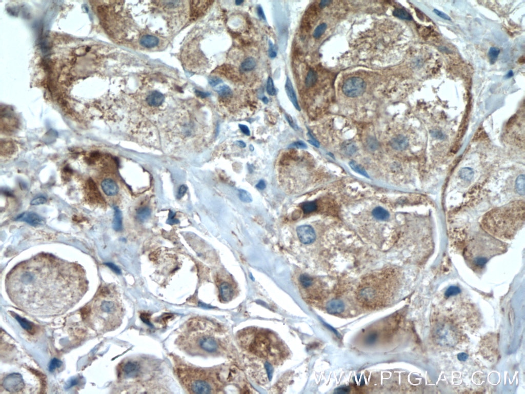 Immunohistochemistry (IHC) staining of human breast cancer tissue using IL-22RA2 Polyclonal antibody (22861-1-AP)