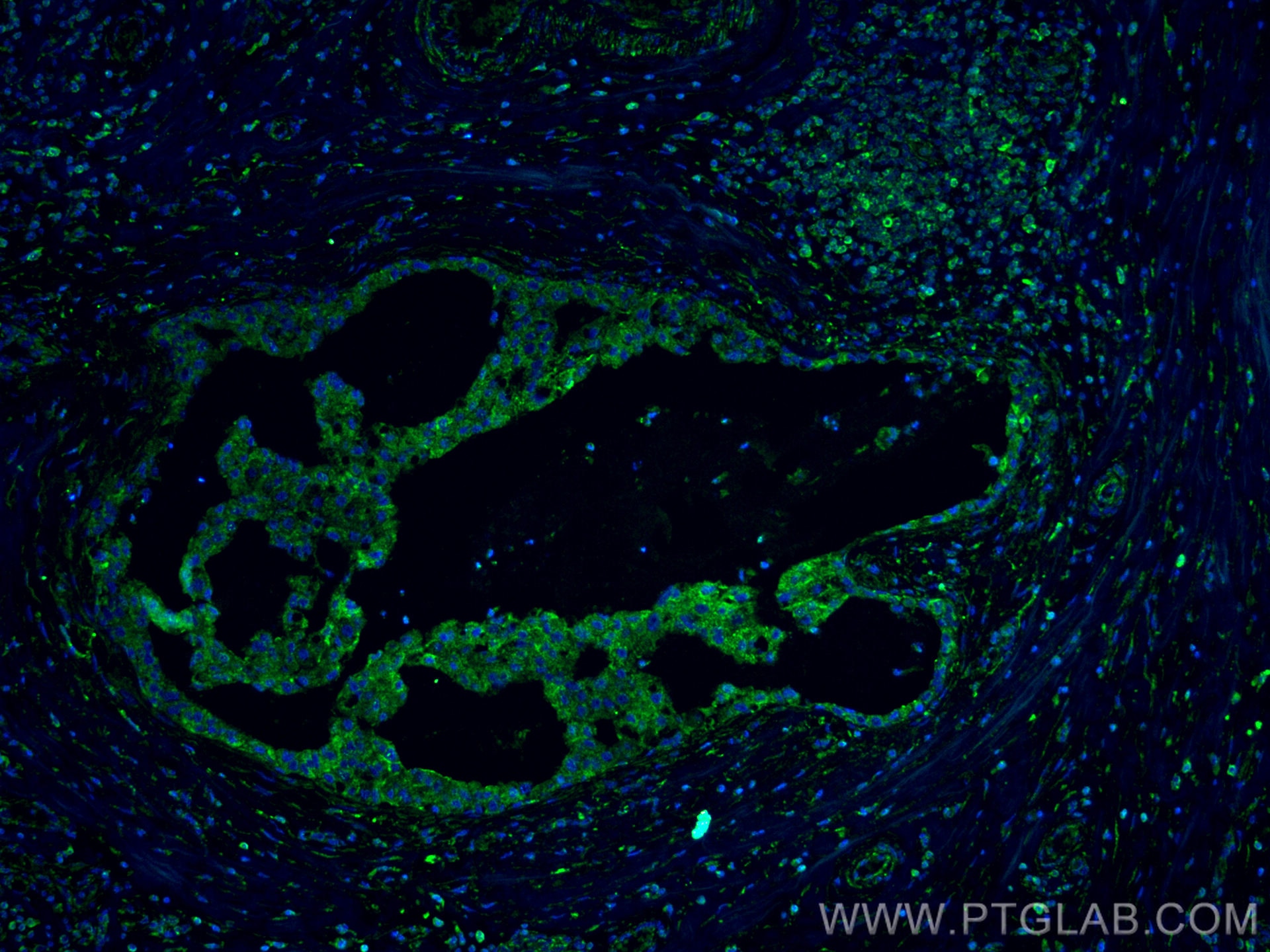 Immunofluorescence (IF) / fluorescent staining of human breast cancer tissue using IL-22RA2 Monoclonal antibody (66190-1-Ig)
