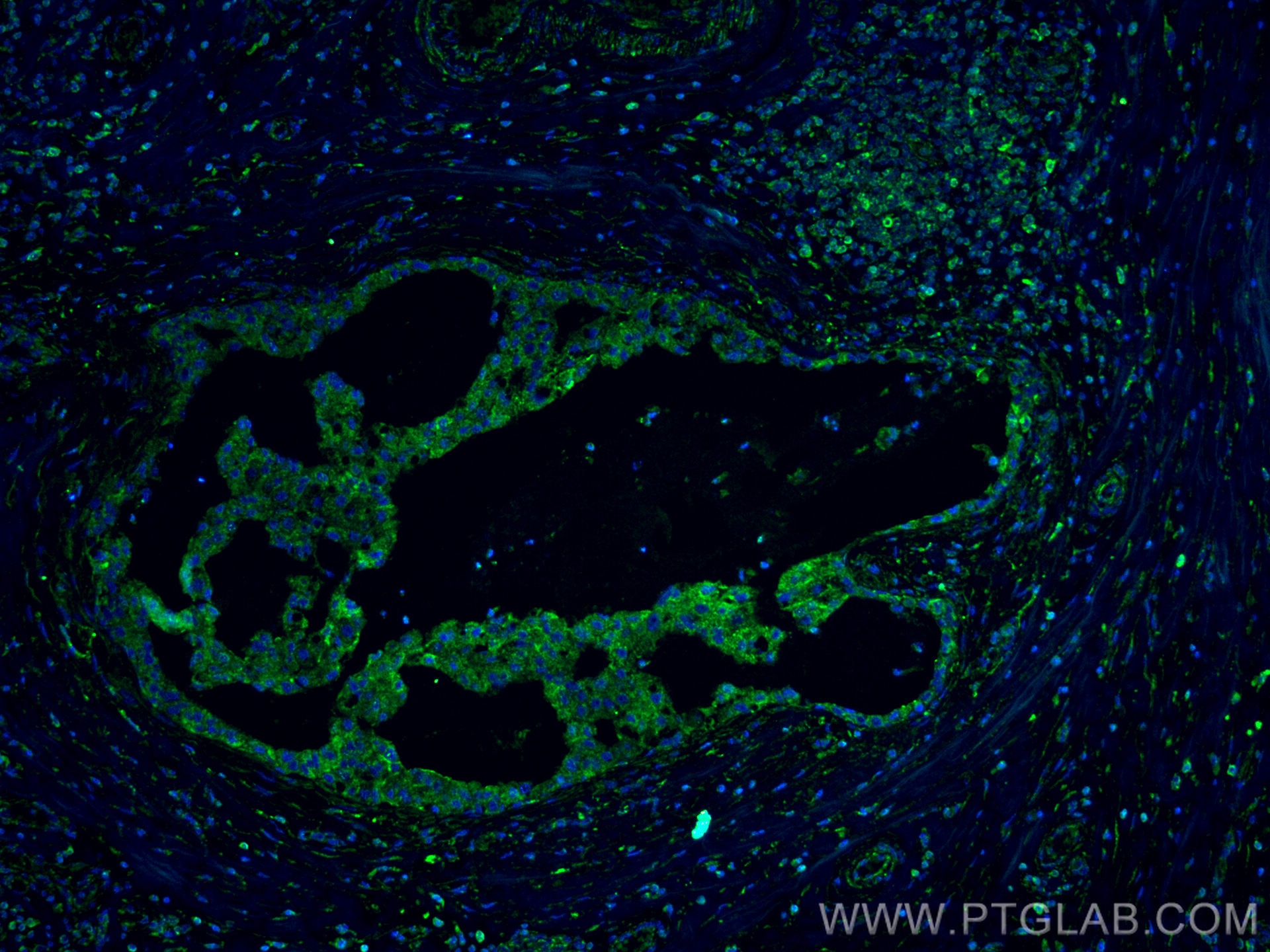 Immunofluorescence (IF) / fluorescent staining of human breast cancer tissue using IL-22RA2 Monoclonal antibody (66190-1-Ig)