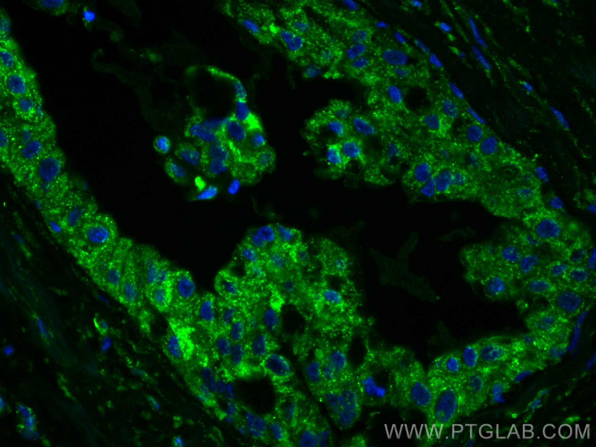 Immunofluorescence (IF) / fluorescent staining of human breast cancer tissue using IL-22RA2 Monoclonal antibody (66190-1-Ig)