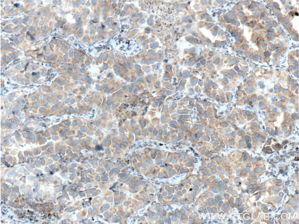 Immunohistochemistry (IHC) staining of human lung cancer tissue using IL-22RA2 Monoclonal antibody (66190-1-Ig)