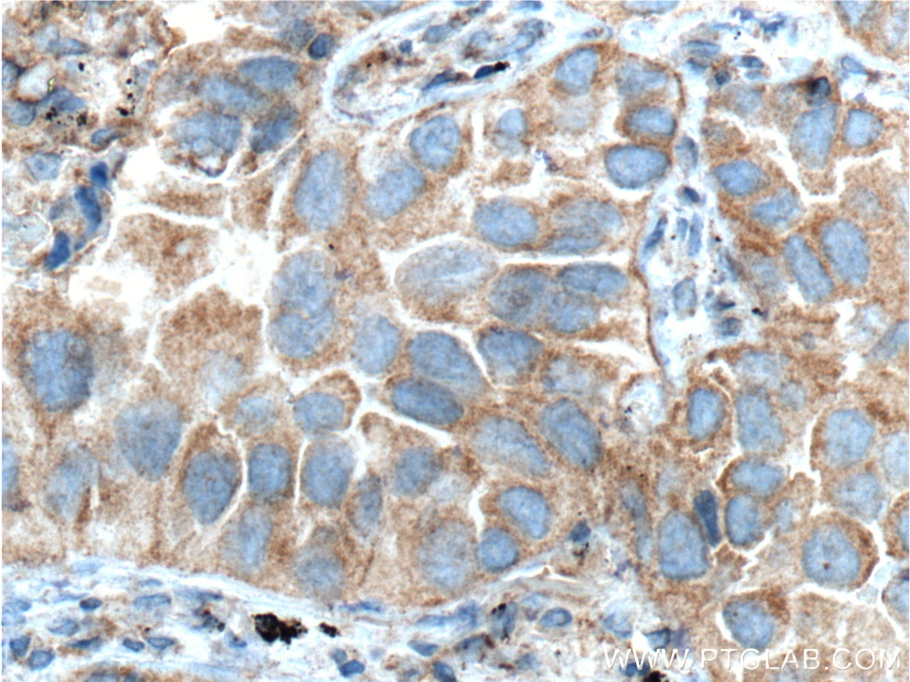 IHC staining of human lung cancer using 66190-1-Ig