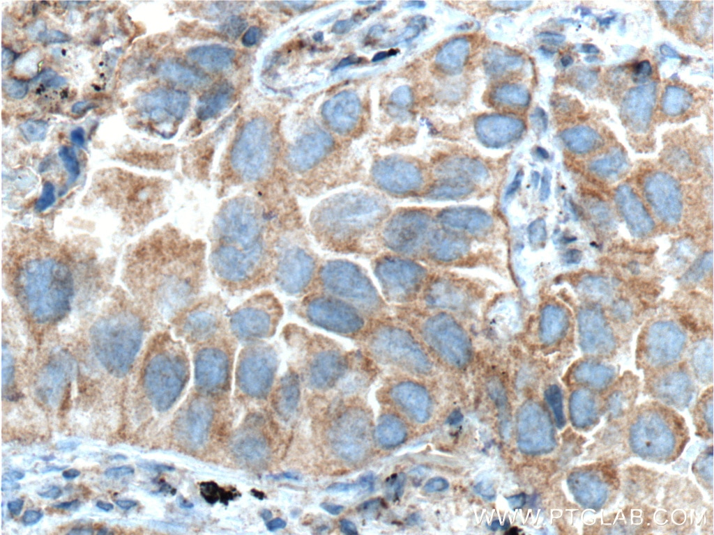 Immunohistochemistry (IHC) staining of human lung cancer tissue using IL-22RA2 Monoclonal antibody (66190-1-Ig)