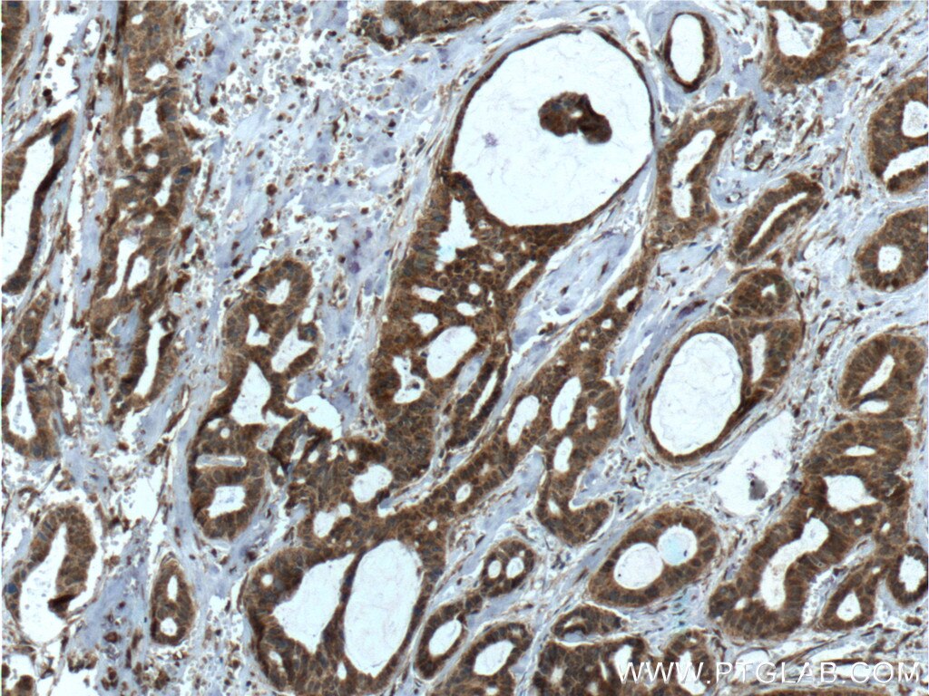 Immunohistochemistry (IHC) staining of human breast cancer tissue using IL-22RA2 Monoclonal antibody (66190-1-Ig)