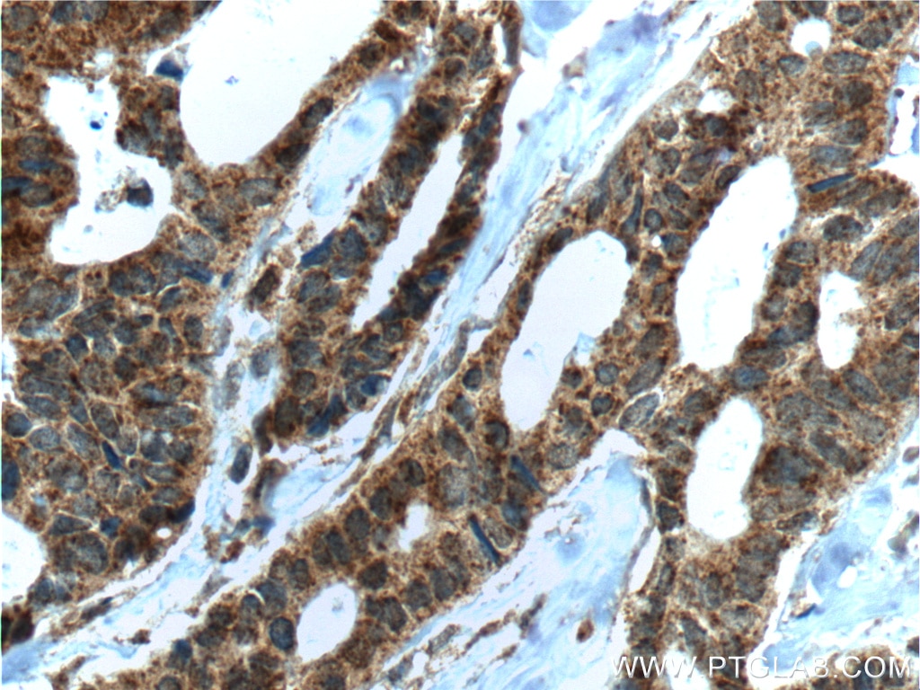 Immunohistochemistry (IHC) staining of human breast cancer tissue using IL-22RA2 Monoclonal antibody (66190-1-Ig)