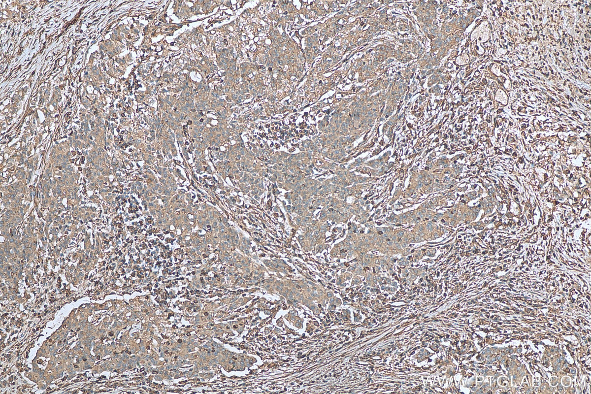 Immunohistochemistry (IHC) staining of human stomach cancer tissue using IL-23A Monoclonal antibody (66196-1-Ig)