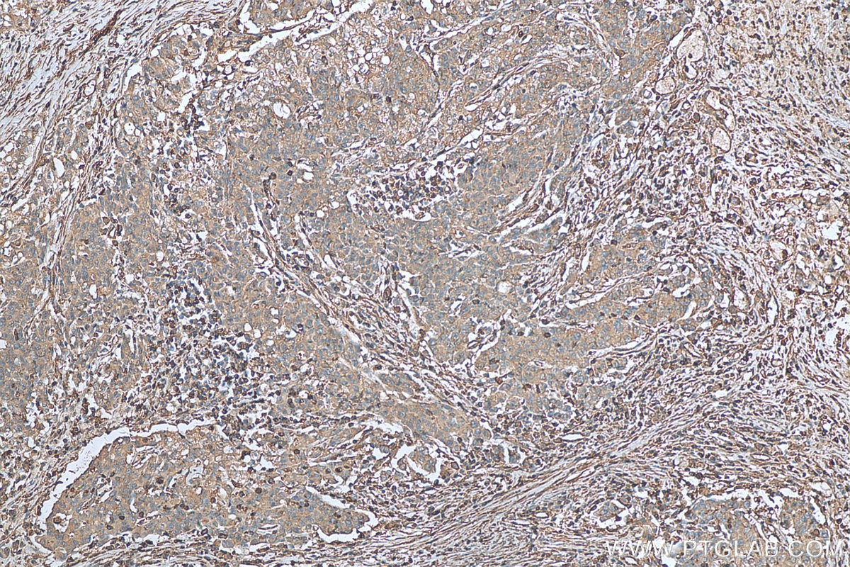 IHC staining of human stomach cancer using 66196-1-Ig