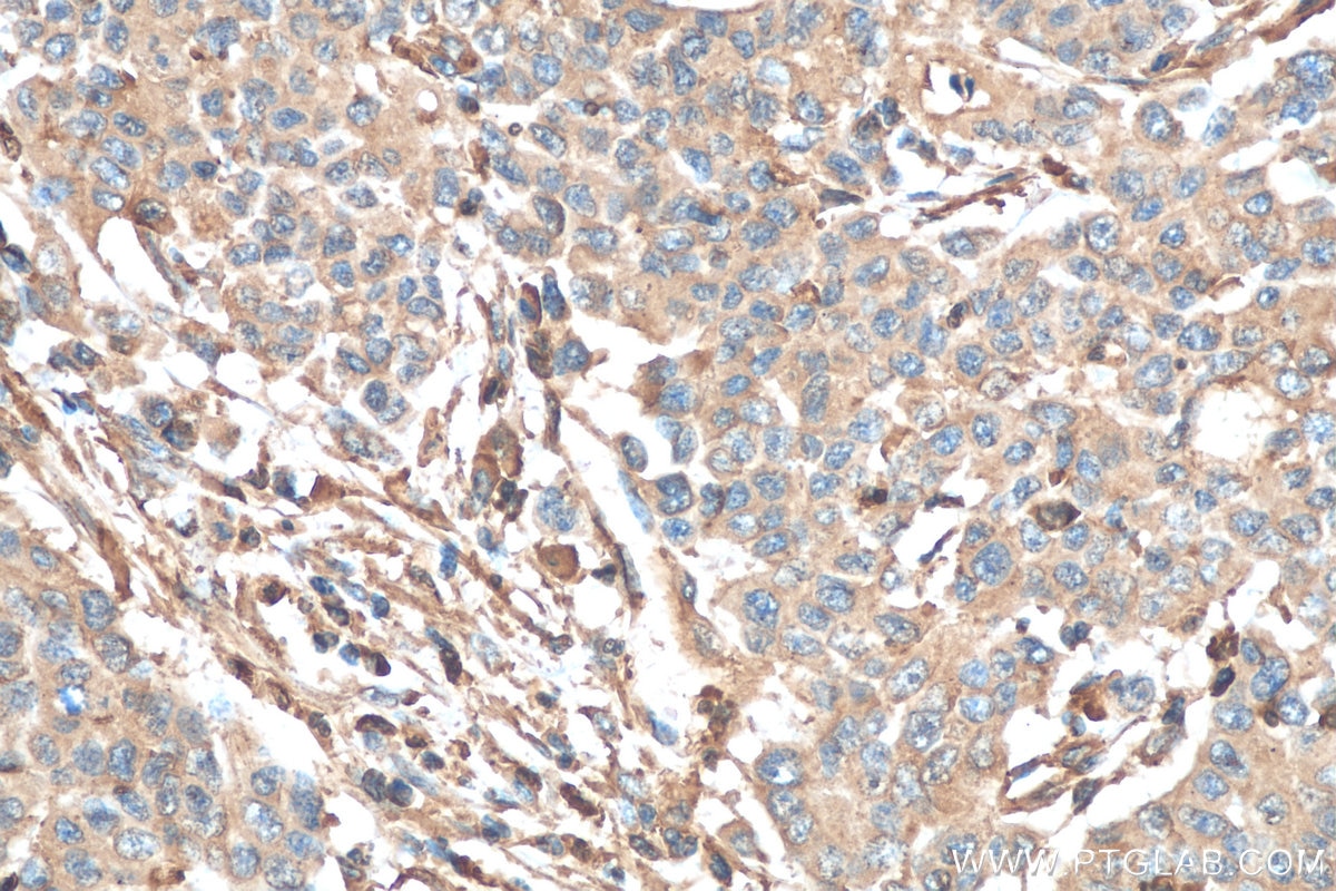 Immunohistochemistry (IHC) staining of human stomach cancer tissue using IL-23A Monoclonal antibody (66196-1-Ig)