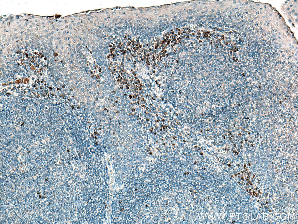 Immunohistochemistry (IHC) staining of human tonsillitis tissue using IL-23R Polyclonal antibody (27163-1-AP)