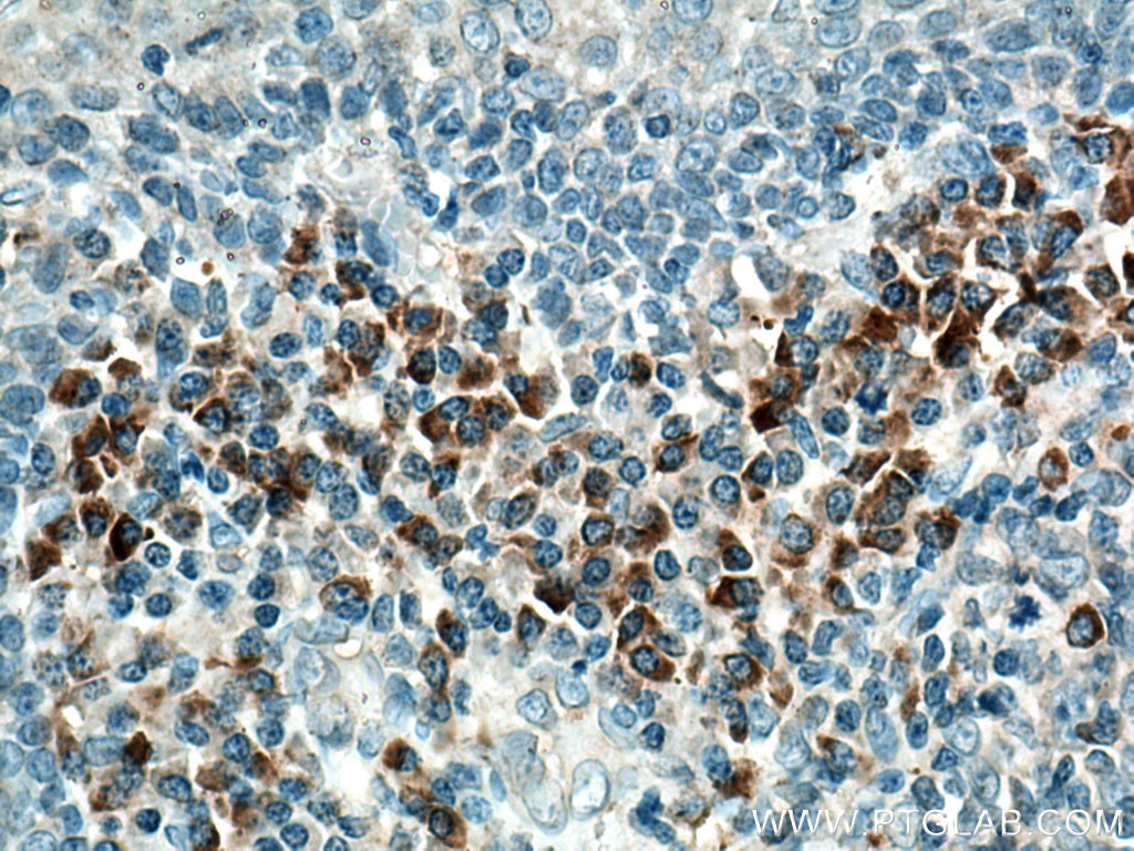 Immunohistochemistry (IHC) staining of human tonsillitis tissue using IL-23R Polyclonal antibody (27163-1-AP)