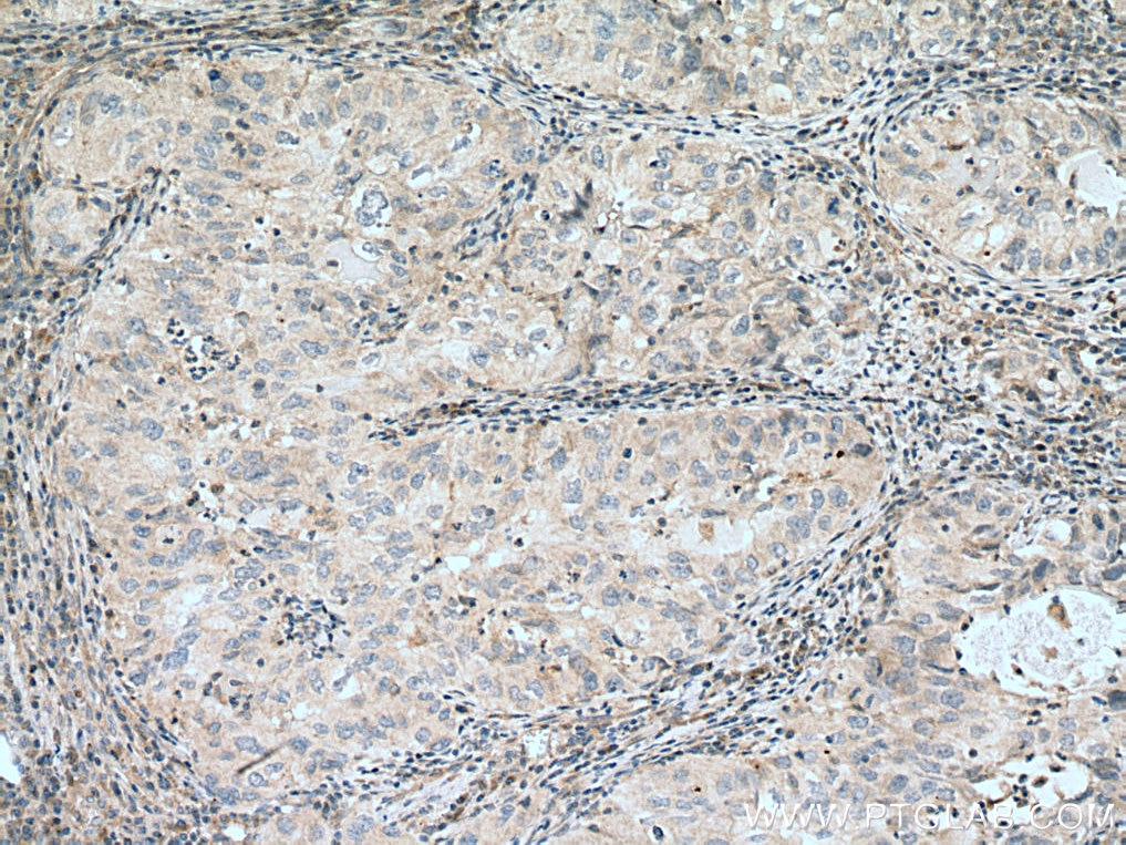 Immunohistochemistry (IHC) staining of human lung cancer tissue using IL-24 Polyclonal antibody (12064-1-AP)