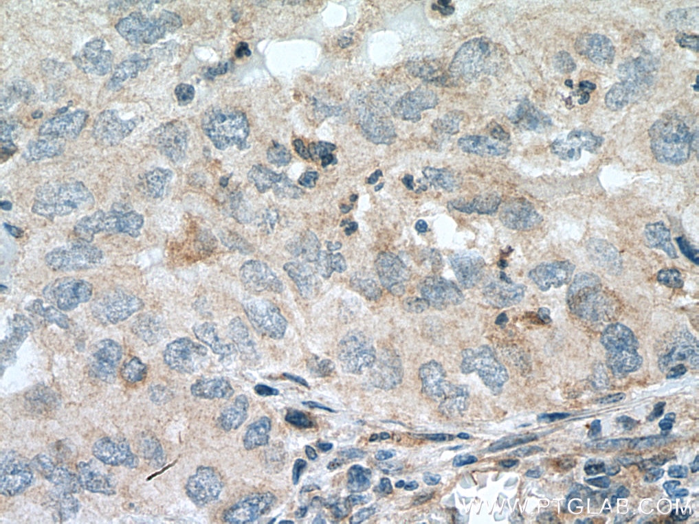 Immunohistochemistry (IHC) staining of human lung cancer tissue using IL-24 Polyclonal antibody (12064-1-AP)