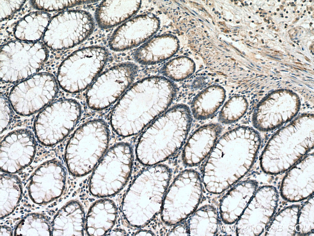 Immunohistochemistry (IHC) staining of human colon cancer tissue using IL-24 Polyclonal antibody (12064-1-AP)