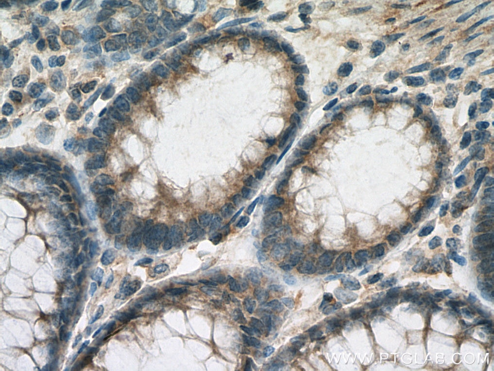 Immunohistochemistry (IHC) staining of human colon cancer tissue using IL-24 Polyclonal antibody (12064-1-AP)